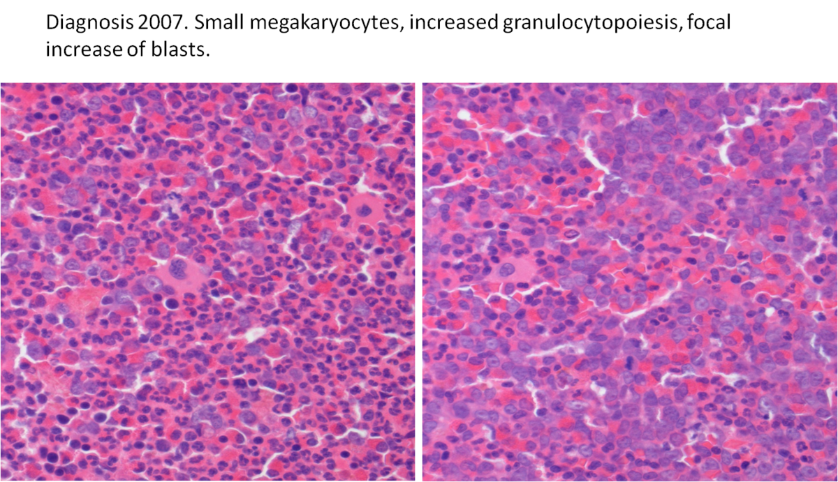 Bone marrow biopsy at diagnosis X 40